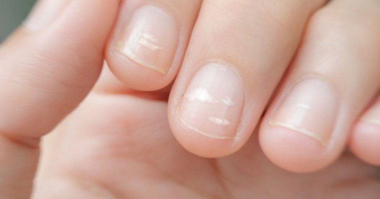 Белые пятна на ногтях. Что они означают и не опасны ли они для здоровья?